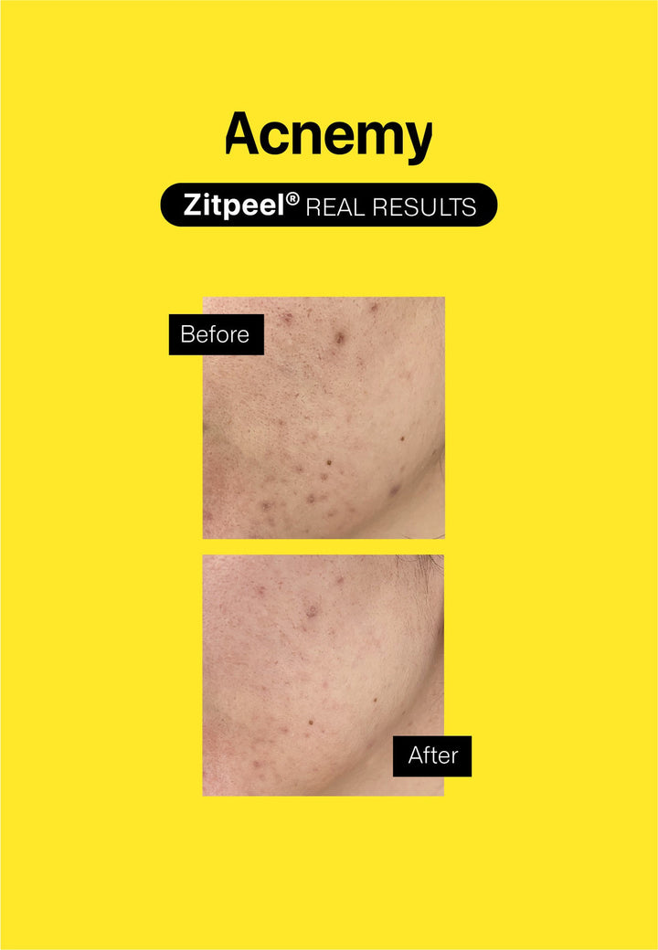 Acnemy ZITPEEL® 𝗔𝗛𝗔 + 𝗕𝗛𝗔 + 𝗣𝗛𝗔 𝗢𝘃𝗲𝗿𝗻𝗶𝗴𝗵𝘁 𝗧𝗿𝗲𝗮𝘁𝗺𝗲𝗻𝘁