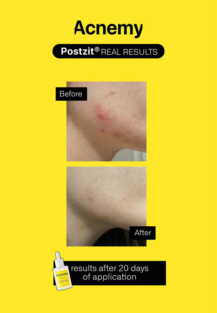 Acnemy POSTZIT® 𝗣𝗼𝘀𝘁 𝗕𝗿𝗲𝗮𝗸𝗼𝘂𝘁 𝗧𝗿𝗲𝗮𝘁𝗺𝗲𝗻𝘁